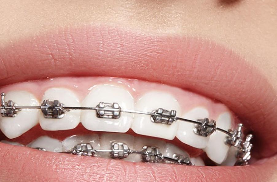 Door corona-achterstand en tekort aan orthodontisten